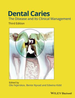 Dental Caries : The Disease and Its Clinical Management